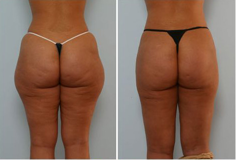 LiposuctionCelluliteTreatmentbeforeafter